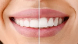 gum contouring