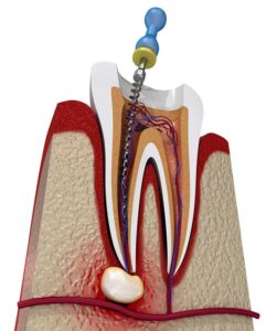 endodontics treatment
